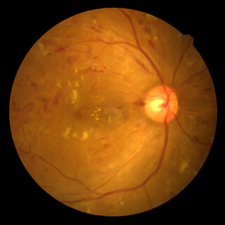 Fluorscein Angioghraphy - Chugh Eye Surgery Centre