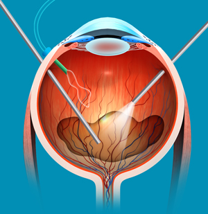 Vitreo Retinal Surgeries