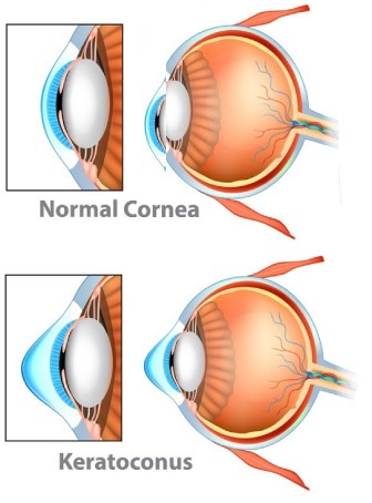 C3R-For-Keratoconus-Chugh-Eye