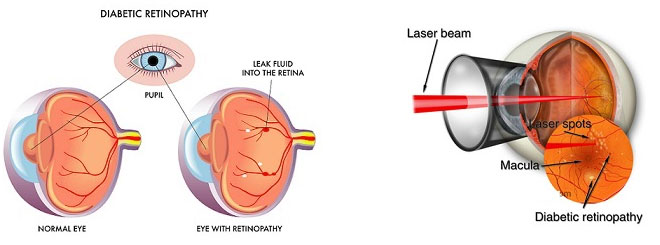Green-Laser-for-Treatment-of-Diabetic-Retinopathy