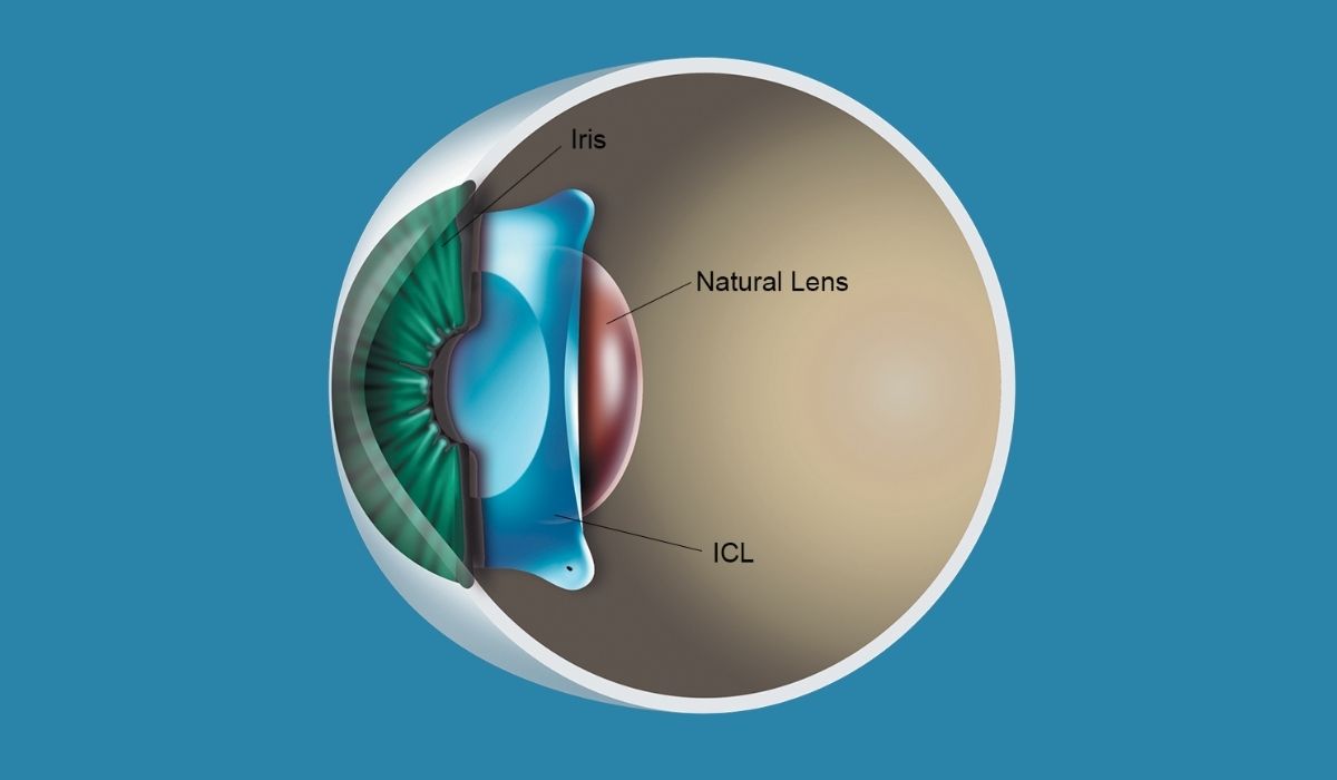 ICL-Implantable-Collamer-Lens