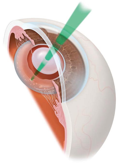 YAG-Capsulotomy-Procedure-chugh-eye